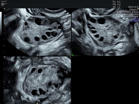 Visualizing PCOS String of Pearls | Ultrasound Diagnosis | Empowered ...