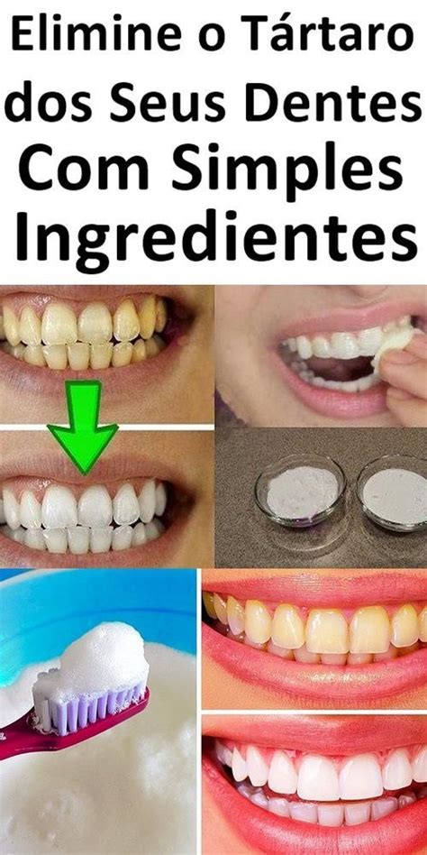 Como Tirar O T Rtaro Dos Dentes A Receita Mais Potente Live Lokai