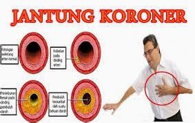 Info Official blog Agung Supriadi: Pengertian Jantung Koroner dan Penyebab, Gejala