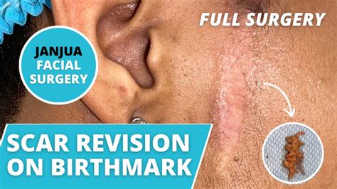 Scar Revision On Birthmark Live Surgery Dr Tanveer Janjua New