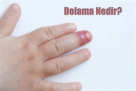 Parmakta şişmeye apseye neden olan dolama nedir Nasıl tedavi edilir