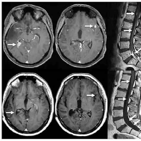 Mri Of Patient Mri Scans T Gadolinium Of Patient No Before