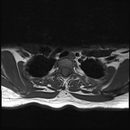 Spinal Meningioma Image Radiopaedia Org