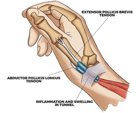 Wrist Joint Samarpan Physiotherapy Clinic