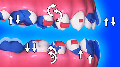 Occlusal Plane Changes In Class Iii Clear Aligner Treatment Biomechanics