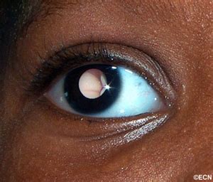 Case 13 Retinoblastoma New York Eye Cancer Center