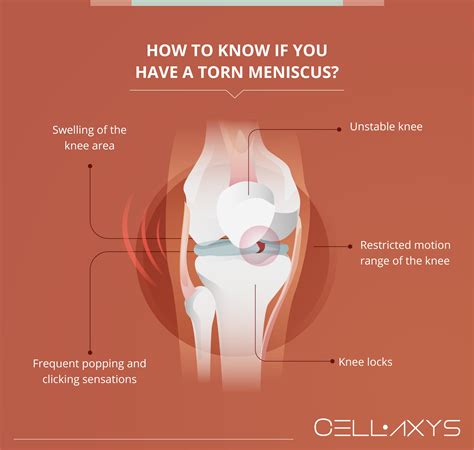 How To Heal A Torn Meniscus Naturally Cellaxys