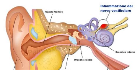 Neurite Vestibolare Cervicale E Vertigini