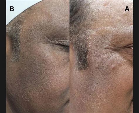 Best Acanthosis Nigricans Doctor In Delhi Acanthosis Nigricans