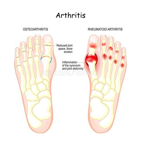 Osteoarthritis, Rheumatoid Arthritis, and Posttraumatic Arthritis Stock Vector - Illustration of ...