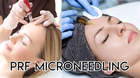 Prf Microneedling Youtube