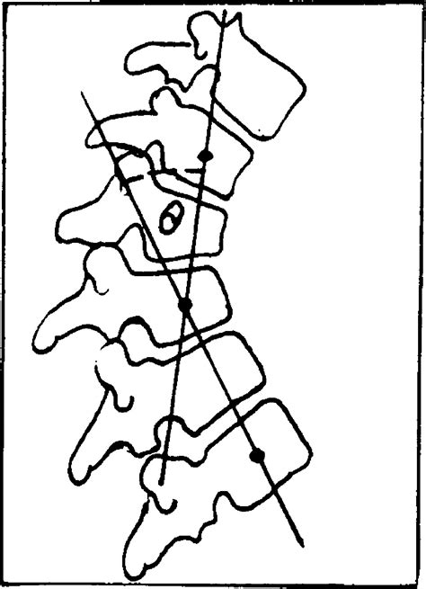 Skin Distraction At Select Landmarks On The Spine Midline In The