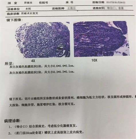 腫瘤病理報告怎麼看？不問醫生就能看懂的技巧（建議收藏） 每日頭條