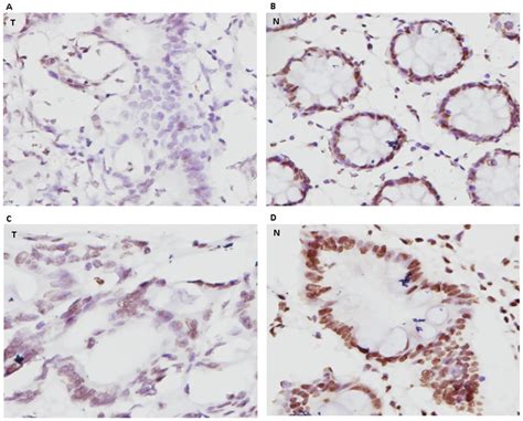 Ihc Staining Of Mlh1 Expression In Tumours And Their Adjacent Normal