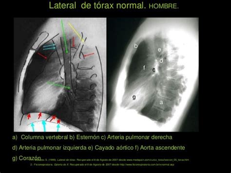 42 Anatomia Descriptiva Y Radiológica En Tele Y Lateral De Tórax