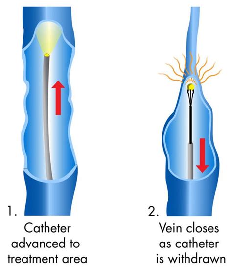 Evlt Nm Nm Endovenous Laser Therapy