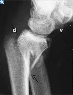 Orthopaedic Surgery CME: X-ray of the day: Smith fracture