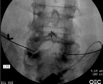 superior hypogastric plexus block - Preferredpaincenter