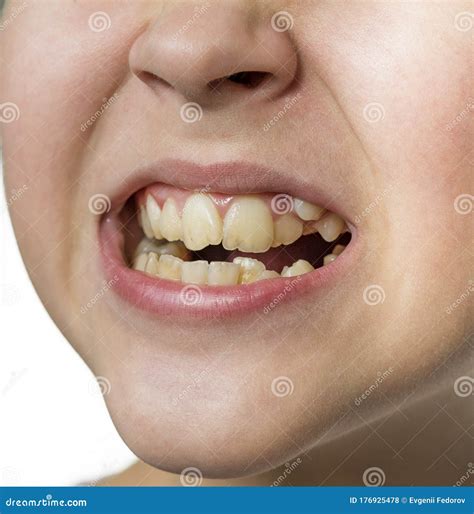 Bad Crooked Teeth Of Young Girl Stock Photo Image Of Mouth