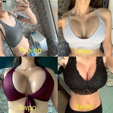 Breast Augmentation Cc Cc Drop And Fluff Progress