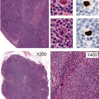 Pdf Cytomegalovirus Lymphadenitis Mimicking A Relapsed Diffuse Large