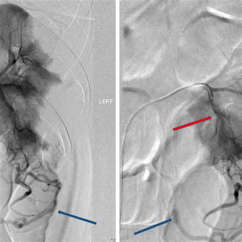 Selective Angiography Of The Left Renal Artery And Lower Renal Artery