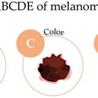 The ABCDE rule for melanoma skin cancer diagnosis. | Download ...