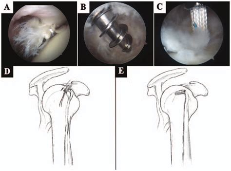 Arthroscopic Proximal Tenodesis Arthroscopy Images Were Of The