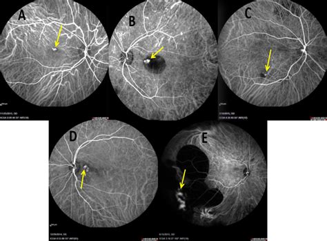 Polypoidal Choroidal Vasculopathy