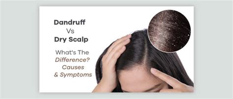 Dandruff Vs Dry Scalp Whats The Difference Causes Symptoms Glowown