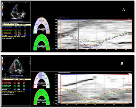 Right Ventricle Global Longitudinal Strain A And Left Ventricle