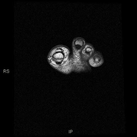 Bizarre Parosteal Osteochondromatous Proliferation Nora Lesion Image