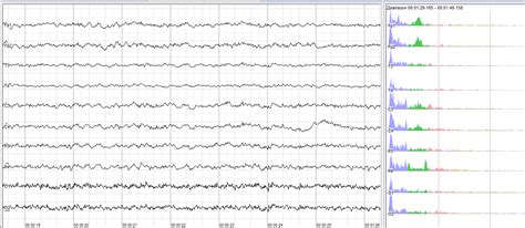 Understanding The Basics Of Electroencephalogram — Firstclass