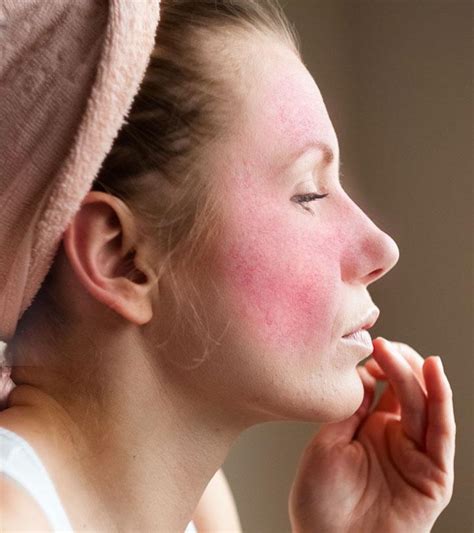 10 Home Remedies For Rosacea That Prevent Redness On The Skin