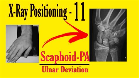 Scaphoid Pa X Ray Positioning Ulnar Deviation X Ray Positioning For Radiographers Youtube