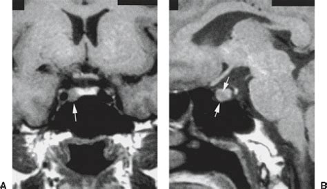 The Sella Turcica And Parasellar Region Radiology Key