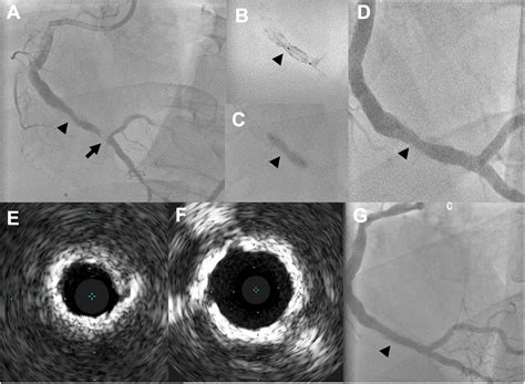 Resolving Chronic Stent Under Expansion In Calcified Lesions By