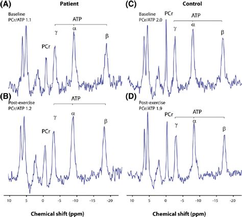 Phosphorus 31 Magnetic Resonance Spectroscopy Representative Spectra Download Scientific