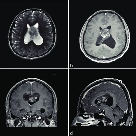 A Axial T2 Weighted Magnetic Resonance Imaging Mri Shows A