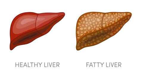 Planning Your Fatty Liver Diet Plan | Fatty Liver Guide