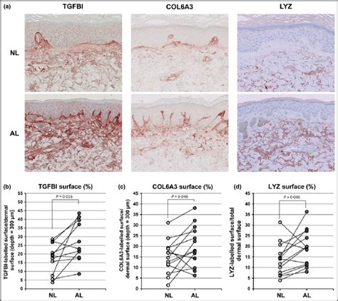 Immunohistochemistry Of Extracellular Matrix Proteins In Actinic