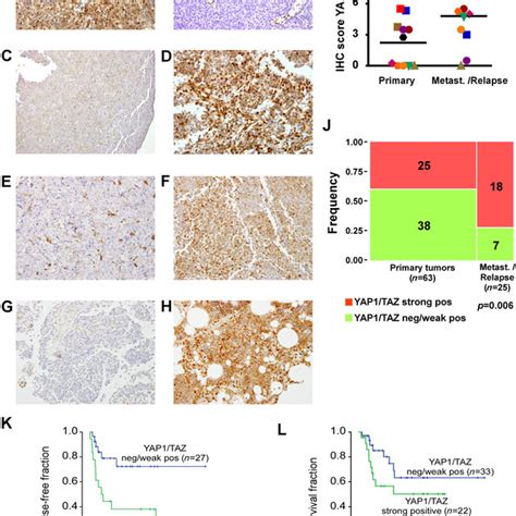 Yap Taz Expression Is Associated With Disease Progression A