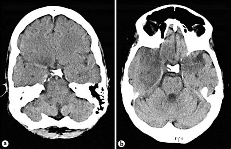 Head Ct Axial View A A Focal Hypodensity Within The Right Temporal