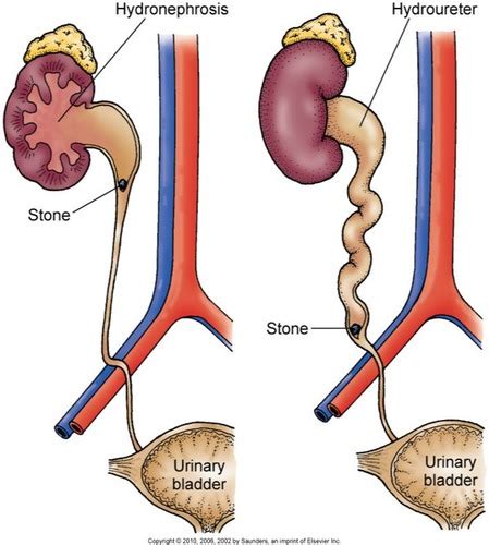 N2240 Alterations Of Renal And Urinary Tract Function Flashcards Quizlet