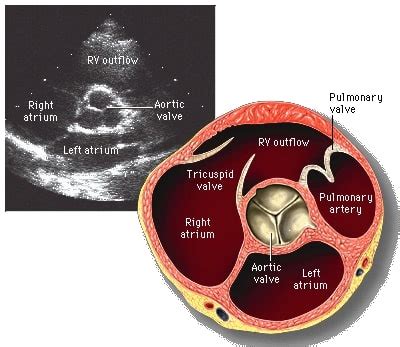 Estenosis A Rtica Concise Medical Knowledge