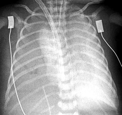 An Overview Of Extracorporeal Membrane Oxygenation Ecmo Paediatrics