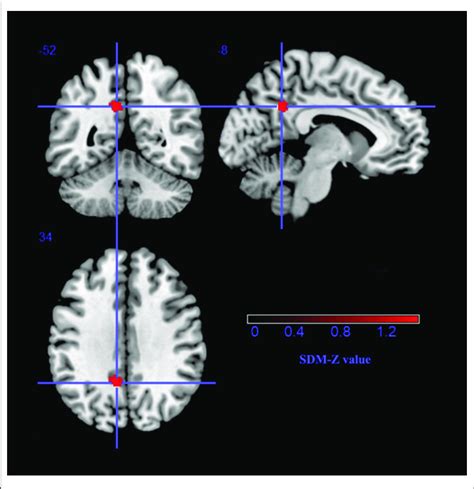 The Gray Matter Volume Reduction In The Left Precuneus Extending To