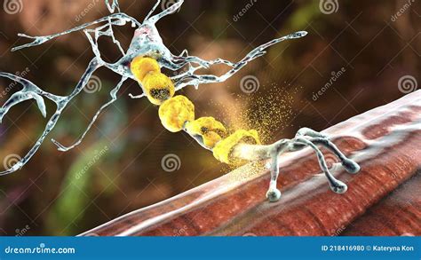 Demyelination of Neuron, the Damage of the Neuron Myelin Sheath Seen in ...