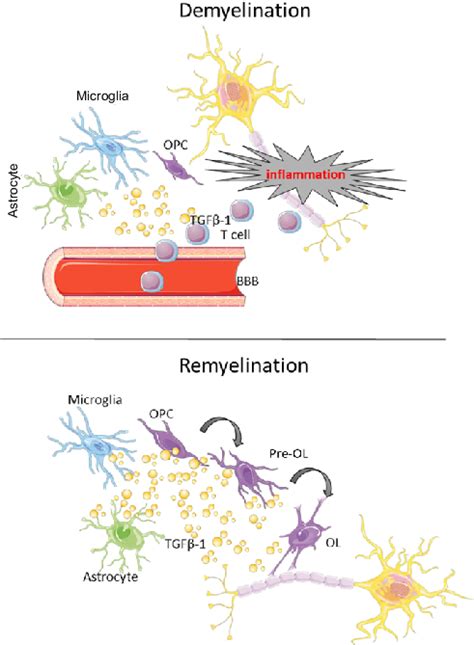 Possible Role Of Transforming Growth Factor β1 Tgf β1 In Multiple