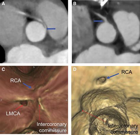 Ischemia In Anomalous Aortic Origin Of A Right Coronary Artery Large